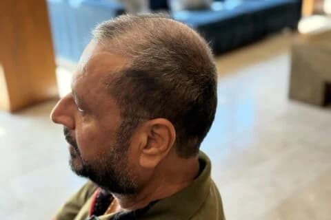 Clinic-published left scalp profile
