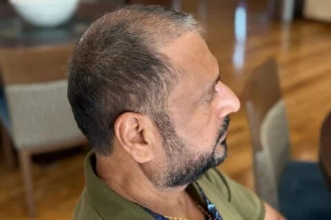 Clinic-published right scalp profile