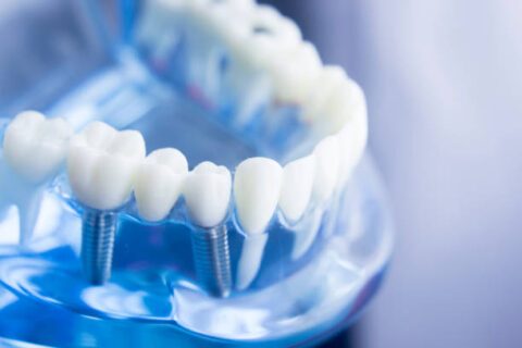 DENTAL IMPLANTS / TEETH IMPLANTS